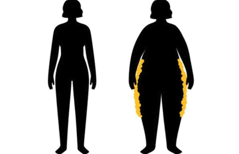 Lipedema: conheça doença confundida com obesidade e que provoca deformação do corpo